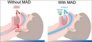 Dispositivo de avance mandibular